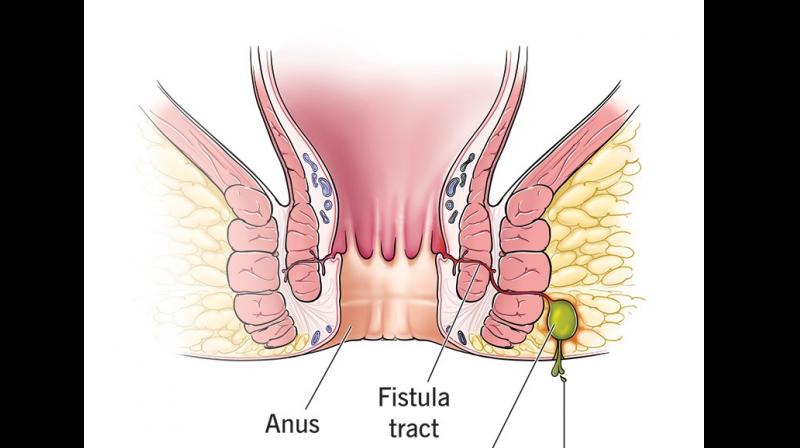 Understanding Fistula: Causes, Symptoms & Modern Treatment Options