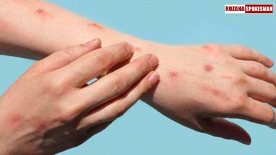 Second Mpox Case Reported in Kerala: Man from UAE Admitted to Kochi Hospital