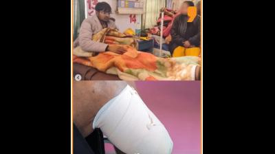 UP Youth Allegedly Chops Off Own Leg to Claim Disability Quota for MBBS Seat