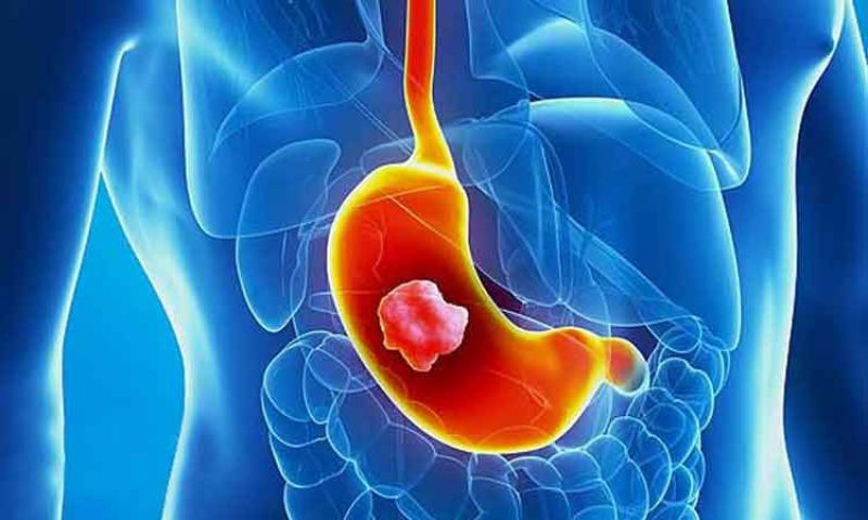 Gastric cancer